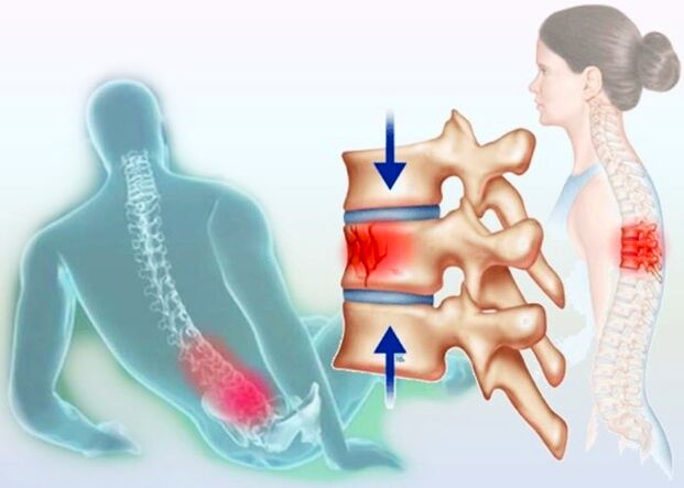 Même une blessure normale peut provoquer le développement d'une ostéochondrose.