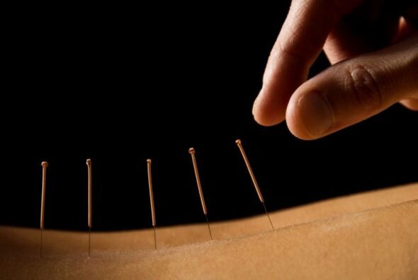 L'acupuncture aidera à éliminer les douleurs lombaires