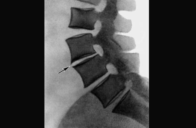 Manifestations d'ostéochondrose de la colonne thoracique sur une radiographie.